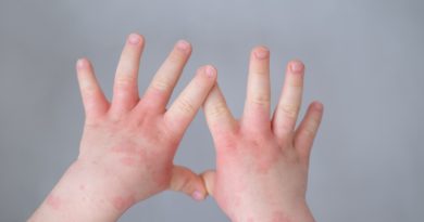 dermatitis atópica en niños