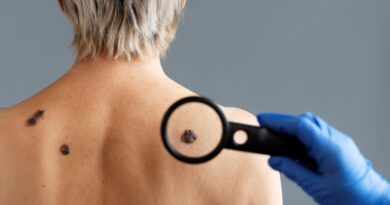 melanoma y AEDV