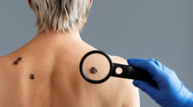 melanoma y AEDV