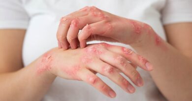 enfermedad psoriásica