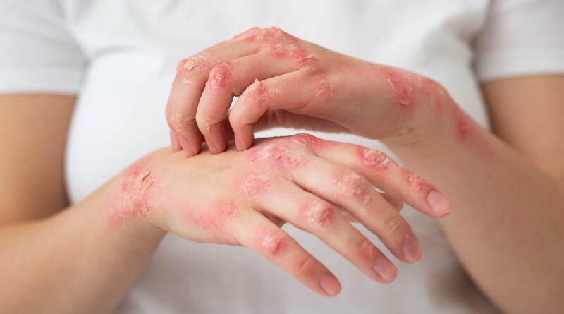 enfermedad psoriásica