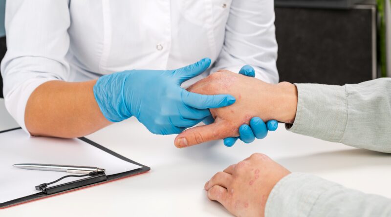 dermatitis atópica grave